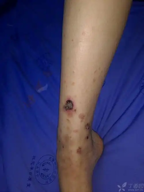 现在考虑变应性皮肤血管炎,目前四肢肌痛症状逐渐加重,血象