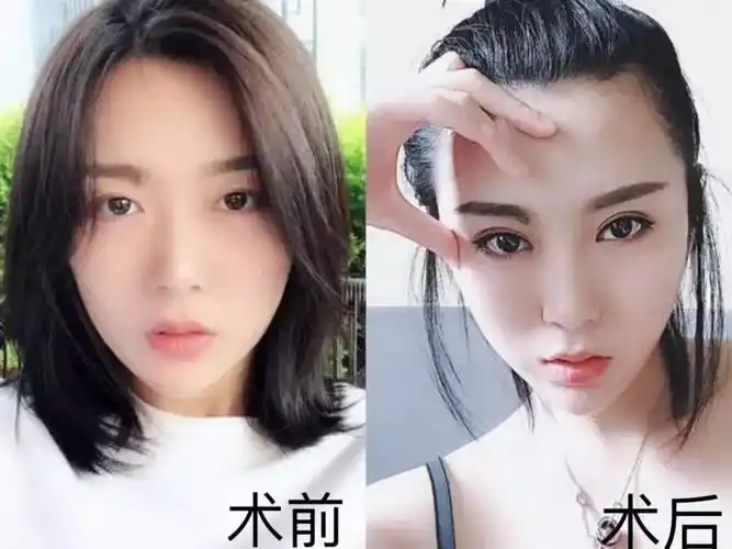 双眼皮比单眼皮好在哪里?(附案例)