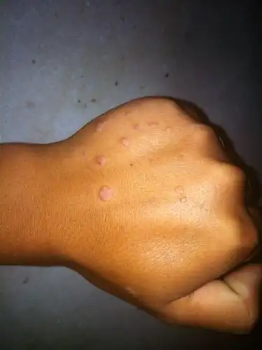 请问这个是鱼鳞吗!如何治?最快!