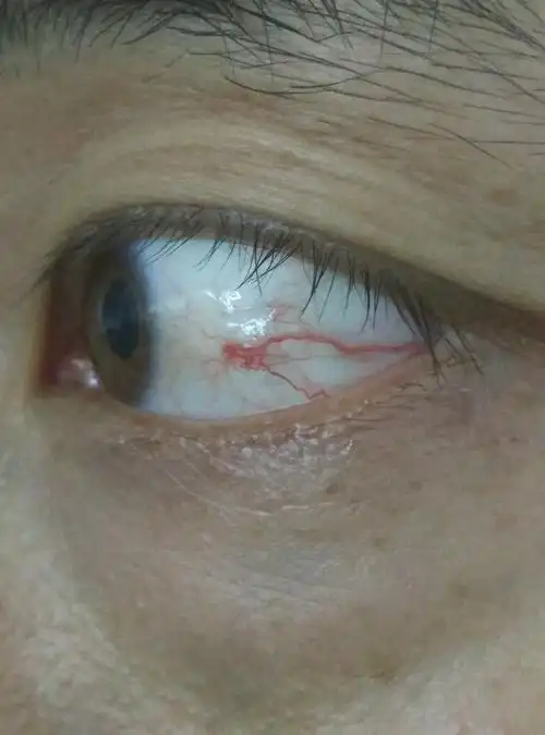 眼睛肿的血丝几年了一直这样,怎么办?