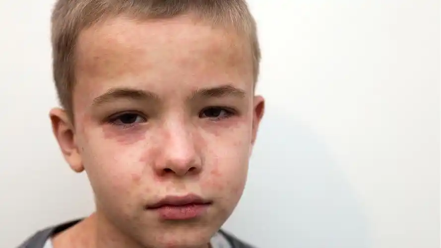 治疗肛周湿疹有没有偏方-肛周湿疹用药-复禾健康