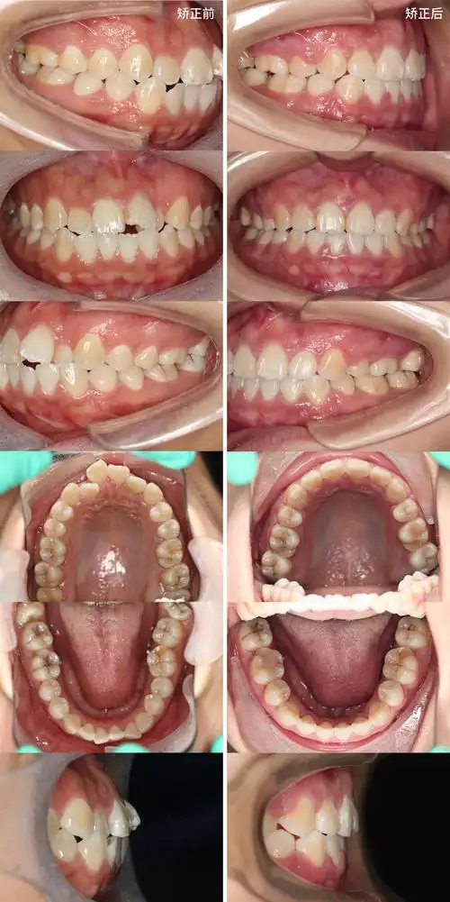 矫正前后口内像对比