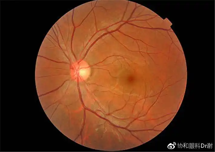 正常视网膜