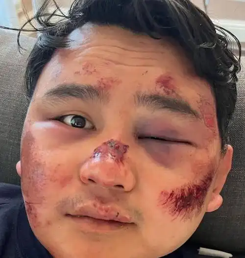 页面上的照片触目惊心,他的额头,脸部,鼻子和嘴唇伤痕累累,脸严重瘀伤