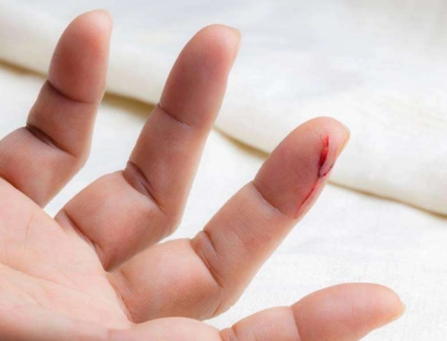 手出血的图片61