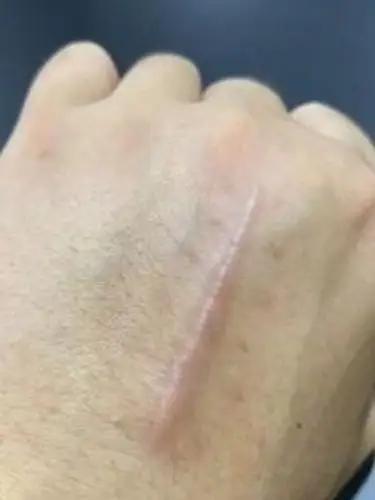 我手上有一个大疤痕,面积挺大的,颜色也更深,听同事_圈子-新氧美容