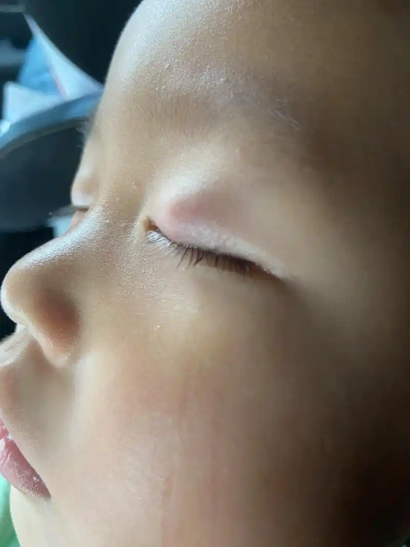 儿子霰粒肿发现过程.5月底开始发现是黄豆大小的凸起,闭上眼睛 - 抖音