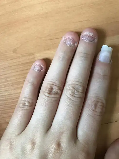 修正咬指甲20170527