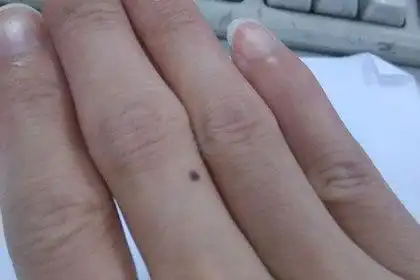 手上长痣揭秘手上中指痣的含义
