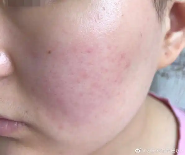 面部皮肤敏感发烫长红斑起小疹子