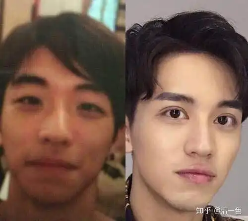 许魏洲只是做了双眼皮手术吗,为什么大学的视频和现在完全不是一个人