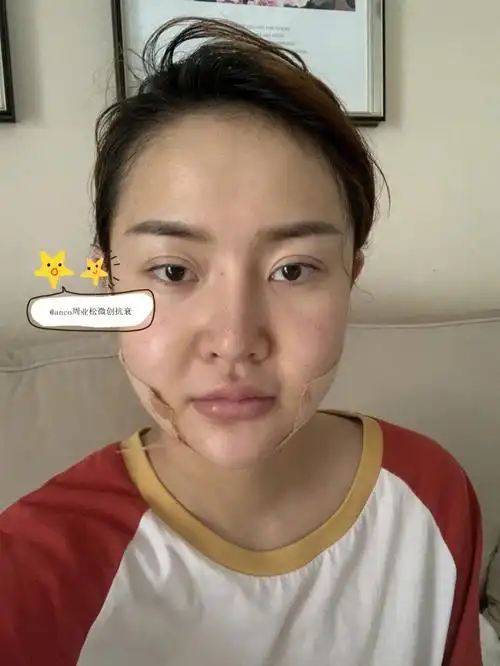 术后day1面部黄金微雕