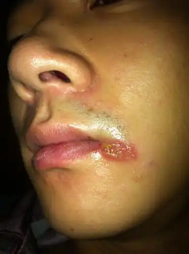 请问嘴角长的一片小包是什么 之前只有一个 弄破了之后有黄水 长出来