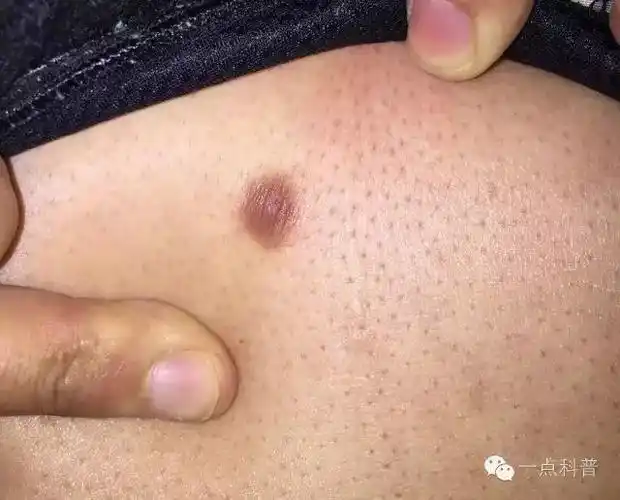 会不会癌变呢?小芳:皮肤纤维瘤一般是良性的,那会不会发生癌变呢?