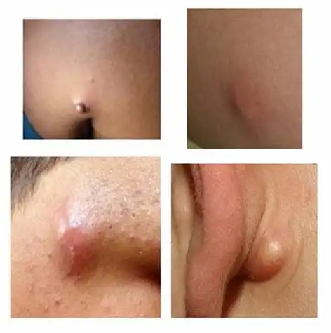 皮脂腺囊肿怎么治疗