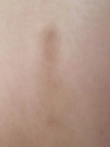 背部正中间 长了两片不知道什么的东西 摸起来不光滑 是癣还是什么