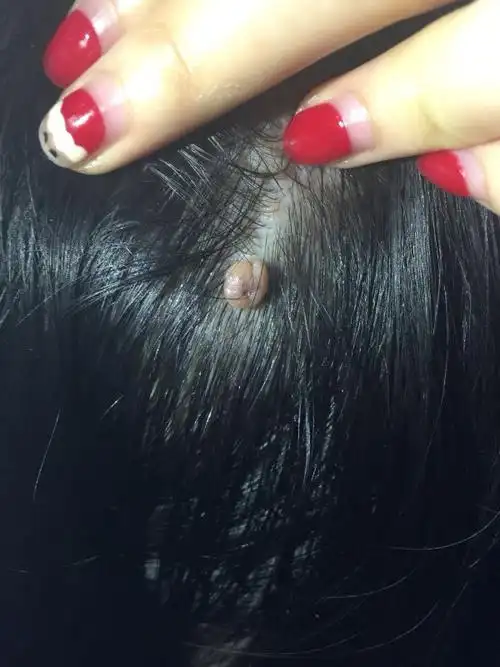 头上长了一个类似瘤子的东西,急啊,求助医生!