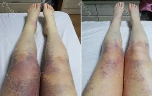 曝光单次抽脂是不是抽的越多越好及术后副作用有哪些