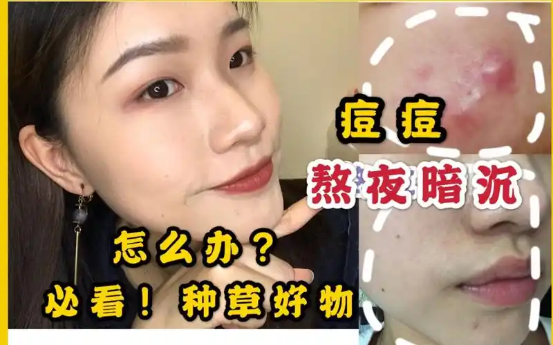 熬夜痘肌必备祛痘提亮好物77这个假期你熬夜长痘了吗熬夜战痘星人