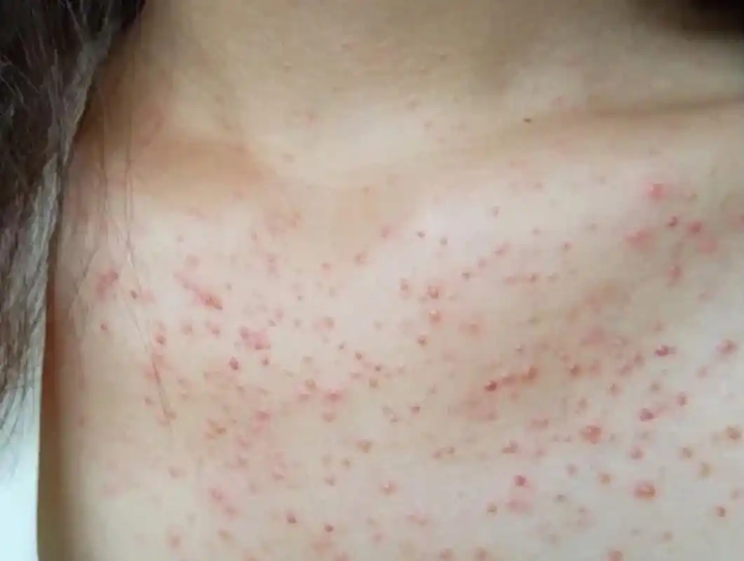 这是两种不同的毛囊炎,处理不一样  第一种——细菌性毛囊炎 01