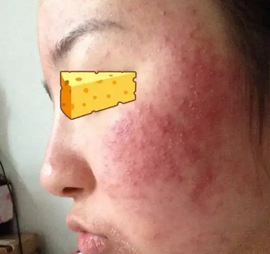 皮肤敏感一化妆就过敏红肿痒起疙瘩是不是激素脸