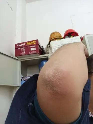 肘部皮肤粗糙,增厚,瘙痒,是真菌感染,还是什么问题?