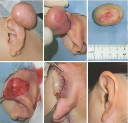 耳廓瘢痕疙瘩手术新技术