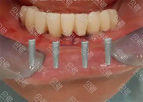 悦康口腔医院好不好本文测评悦康口腔种植牙技术附地址