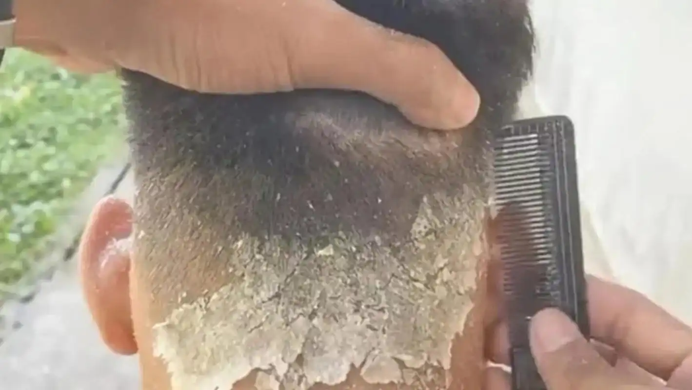 我愿称之为史上最大头皮屑[泪奔]