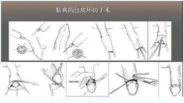 转载网易健康频道专访:谈包皮环切和男性健康
