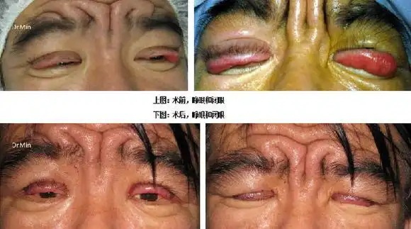 特殊疾病造成的眼睑下垂及外翻