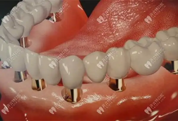 半口种植牙的图