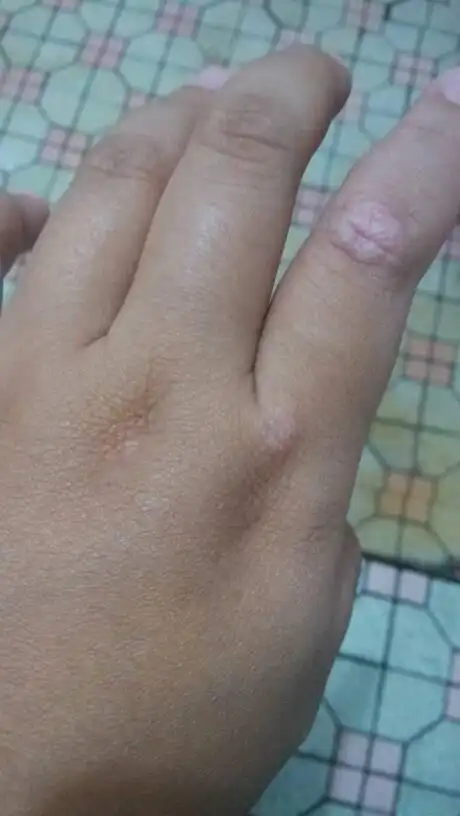 我想问我手指关节那长的是什么,又痒有疼,有人说是癣,半个月了要怎么