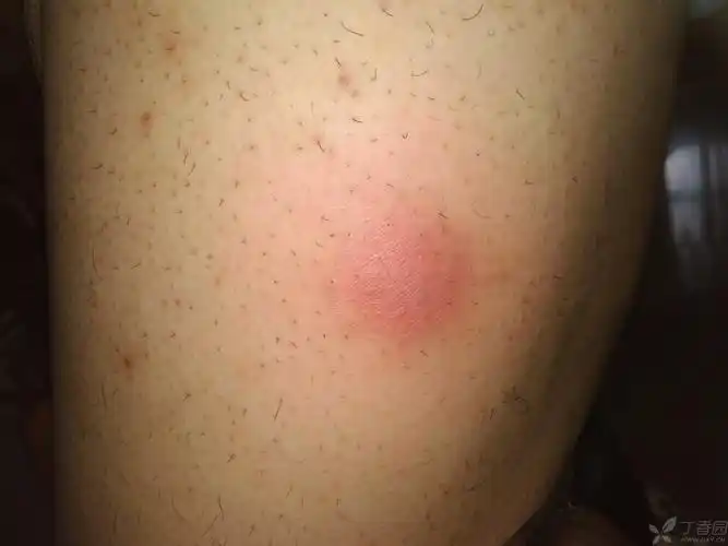 毛囊炎? tttok 04-26 08:53          关注      点赞 收藏