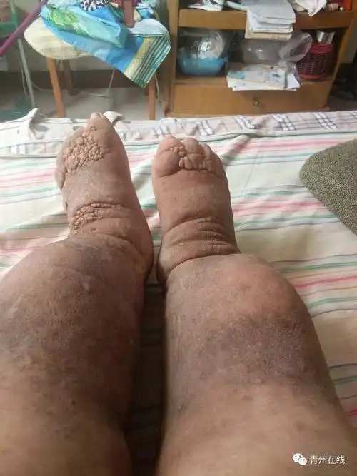 姓名:张立荣我是个先天性淋巴水肿的病人,双下肢肿的像两根大象腿