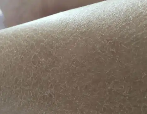 鱼鳞病的最佳治疗时期是什么时候