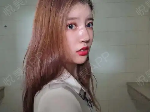 自体脂肪面部填充术后7天_面部填充术后7天_自体脂肪术后7天_悦mer