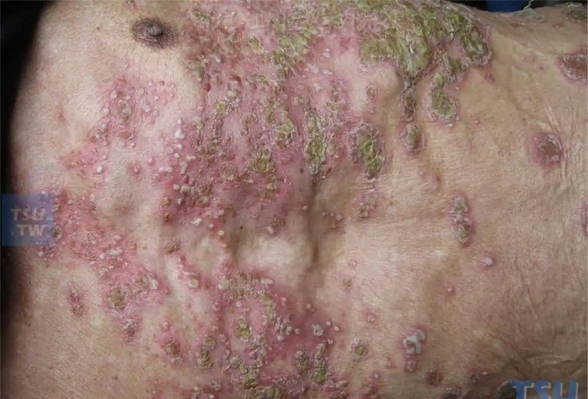 (1)泛发性脓疱型银屑病: 大多急性发病,可在数周内泛发全身, 常伴有