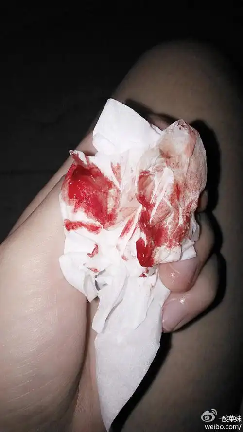 酸菜妹:脚趾被撞得流血了,以前是右脚,现在是左脚,看来最后的左右小