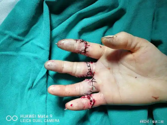 市二院显微外科断指重生记