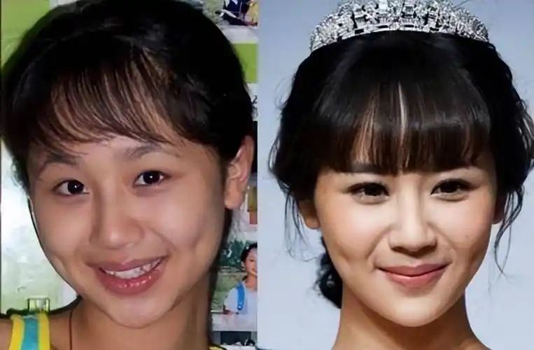 杨紫被质疑整容,脸部僵硬浮肿,网友:玻尿酸都要溢出来了_五官_人们_鼻