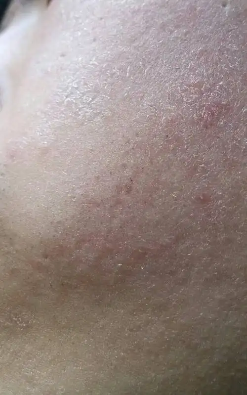 洗脸之后会有紧绷感.时间很久了,是太干燥了吗?需要用点什么药?