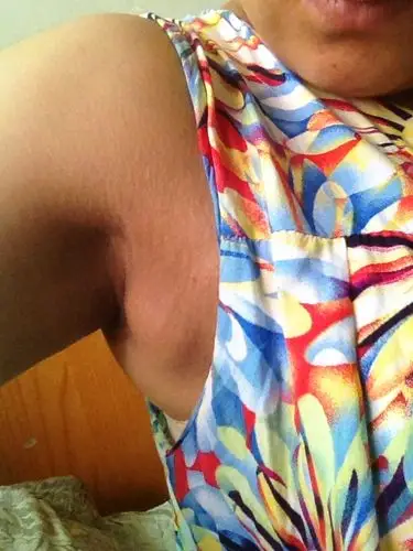 我腋下长这个肉疙瘩.