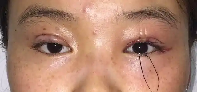 单眼先天性上睑下垂手术矫正效果(有图有真相)