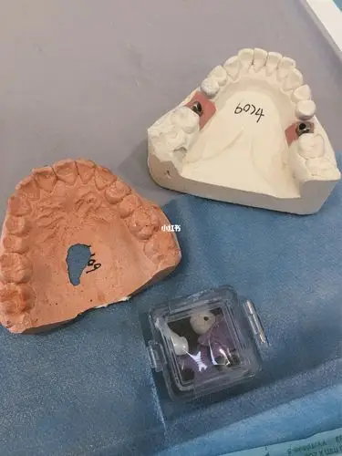 种植牙| 没戴成功,重新取模!