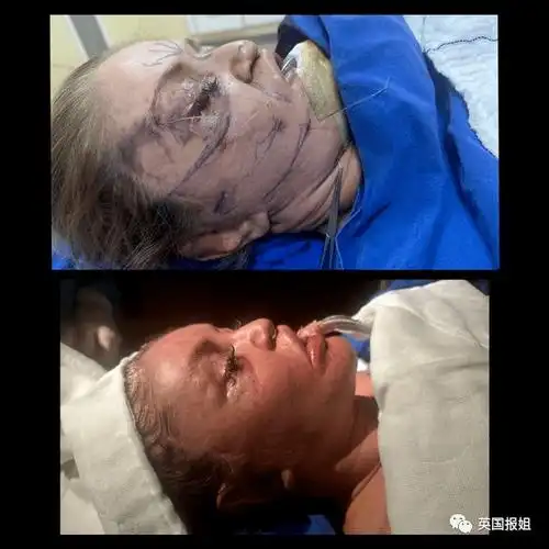 英国美貌女星整容失败全脸毁容!