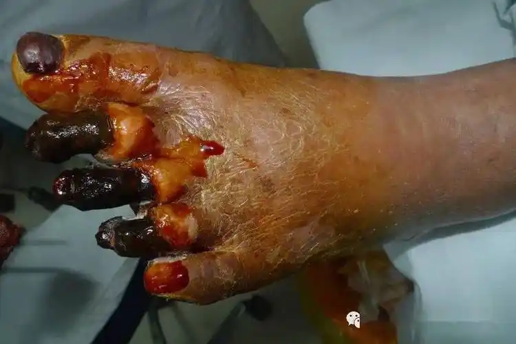 一例足趾发黑坏疽的糖尿病足治疗_伤口