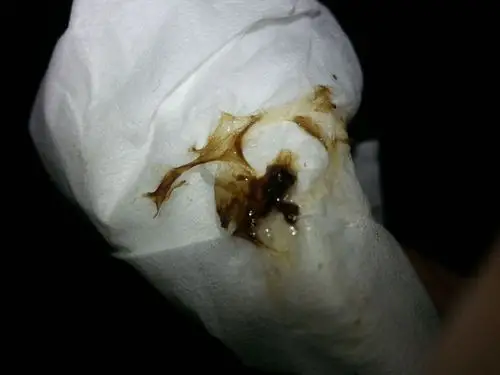 白带带血是深色的像咖啡色