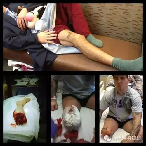 时候要改变,他要摆脱伊拉克腿伤的梦魇,他做了疯狂的决定,把右腿截肢