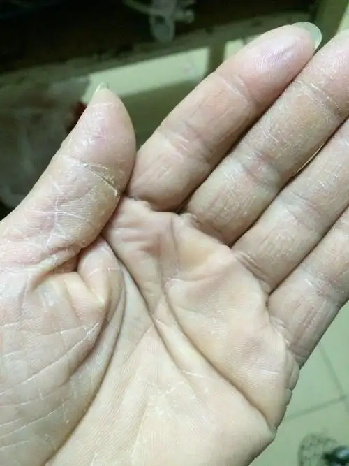 冬季皮肤干燥,手指裂开了口子.疼的厉害!如何解决!谢谢各位亲.